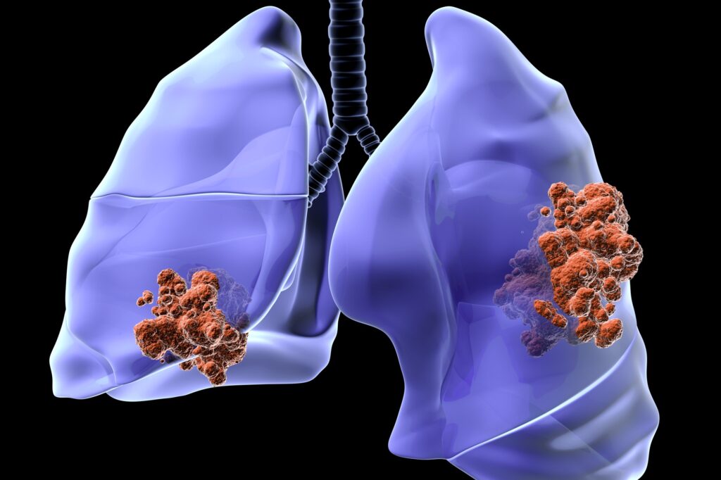 Nodule Pulmonaire : Comprendre les Symptômes, le Diagnostic et la Gestion
